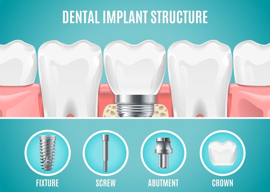 Screws that Chew: Dental Implants to the Rescue